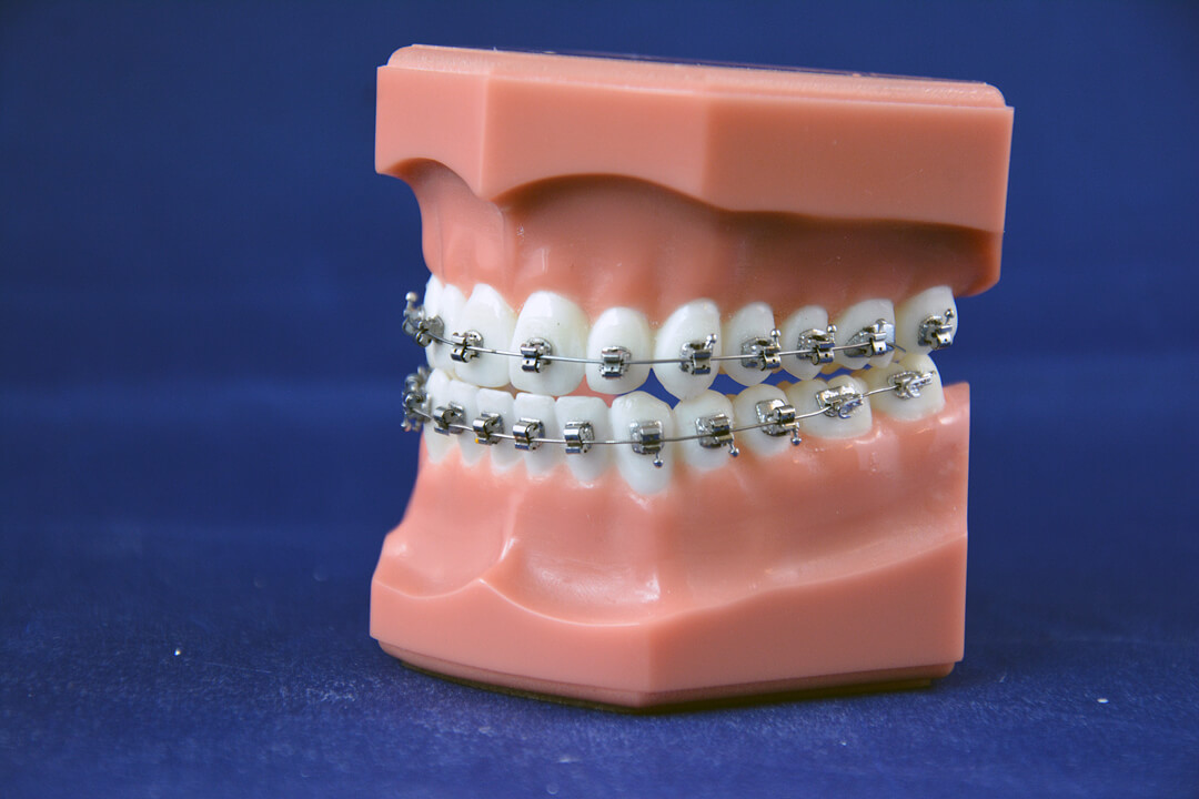 appareil orthodontique fixe